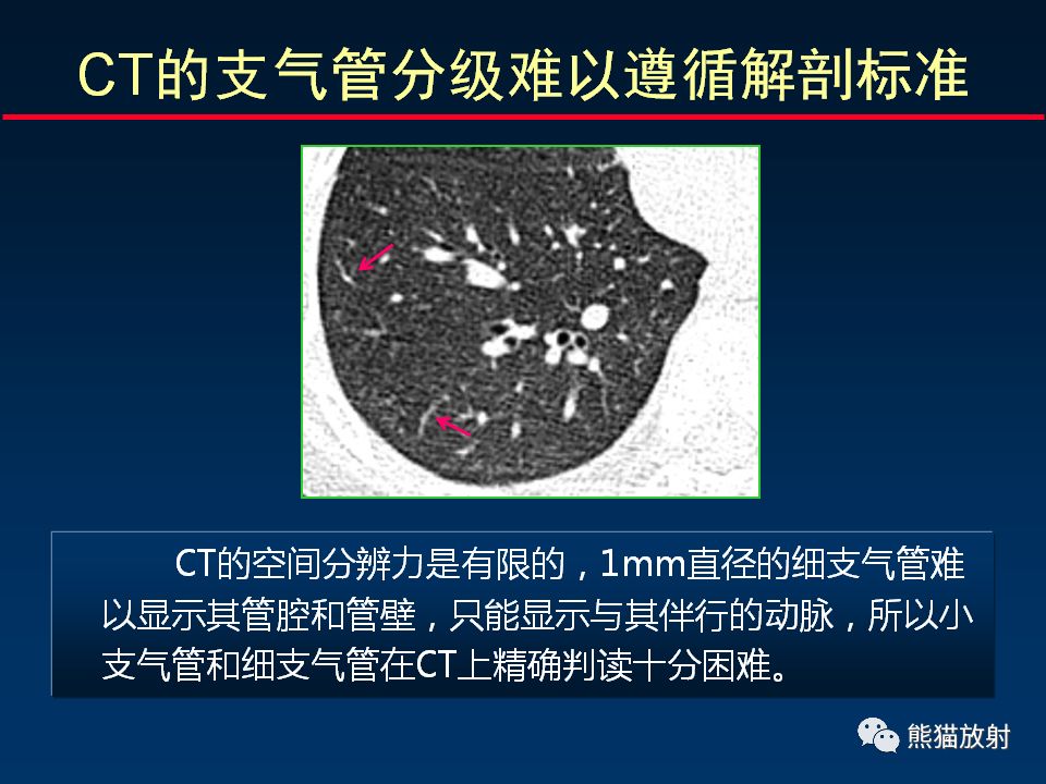【PPT】正确判读支气管异常的CT征象 【PPT】正确判读支气管异常的CT征象