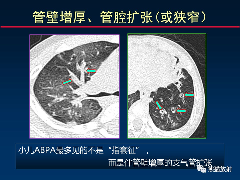 【PPT】正确判读支气管异常的CT征象 【PPT】正确判读支气管异常的CT征象