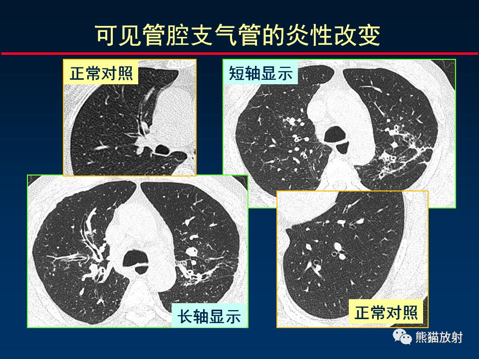 【PPT】正确判读支气管异常的CT征象 【PPT】正确判读支气管异常的CT征象