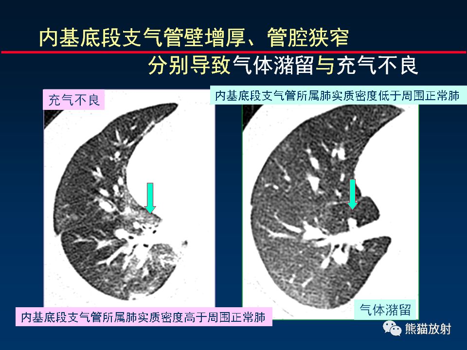 【PPT】正确判读支气管异常的CT征象 【PPT】正确判读支气管异常的CT征象