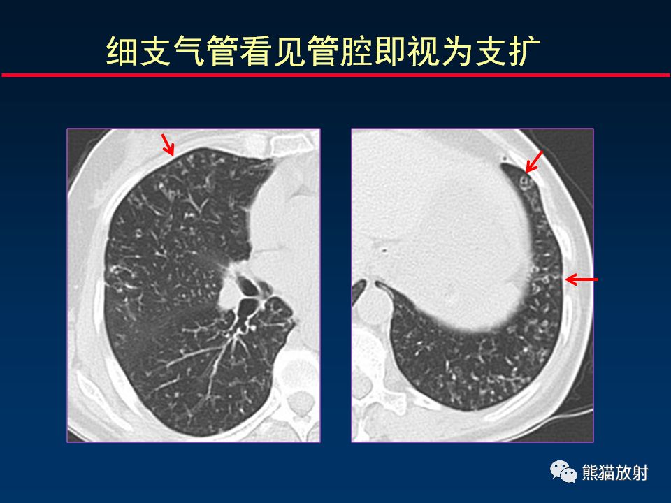 【PPT】正确判读支气管异常的CT征象 【PPT】正确判读支气管异常的CT征象