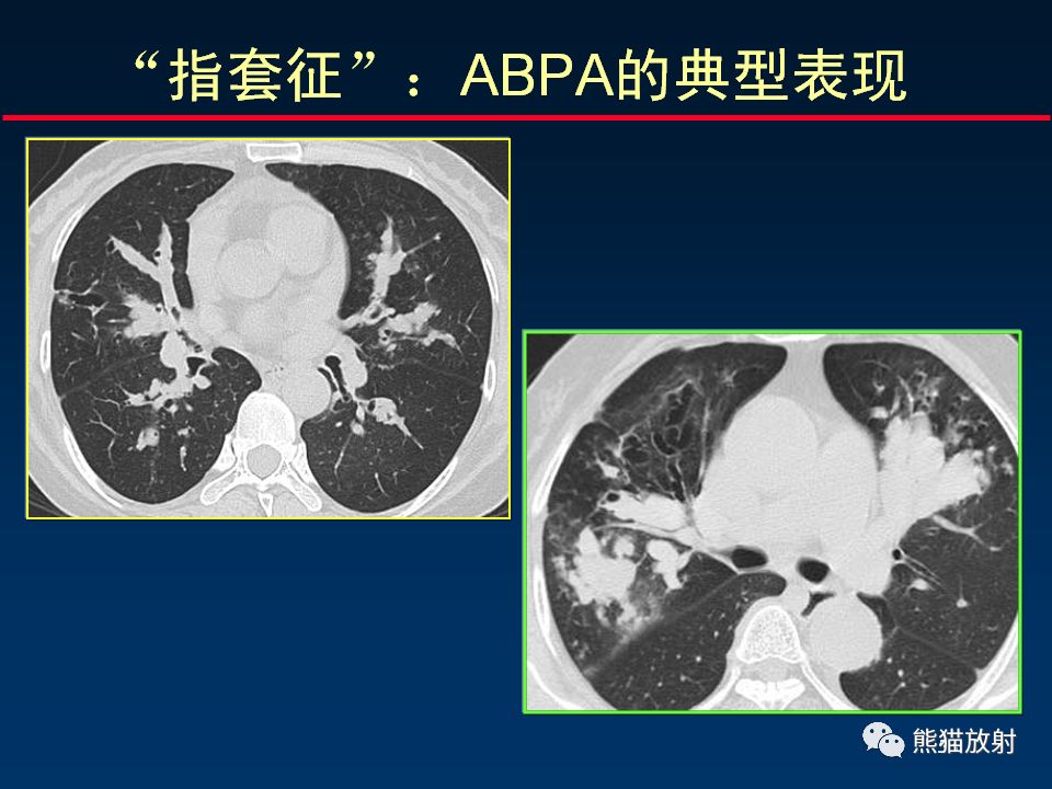 【PPT】正确判读支气管异常的CT征象 【PPT】正确判读支气管异常的CT征象