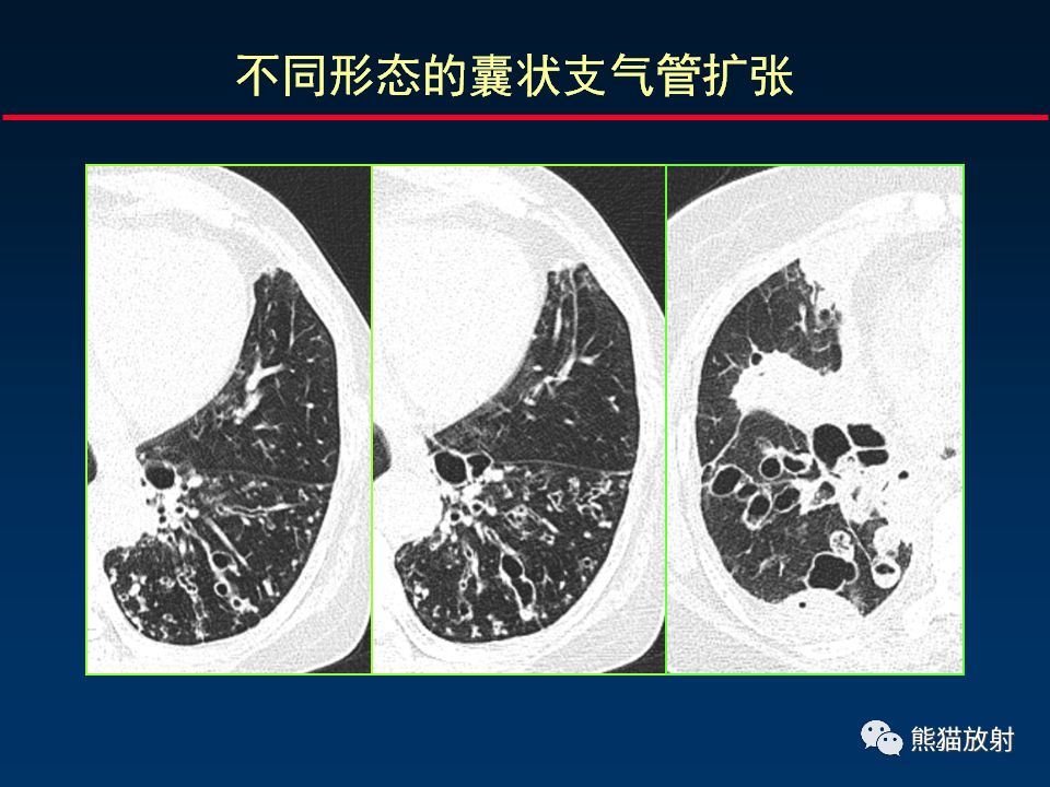 【PPT】正确判读支气管异常的CT征象 【PPT】正确判读支气管异常的CT征象