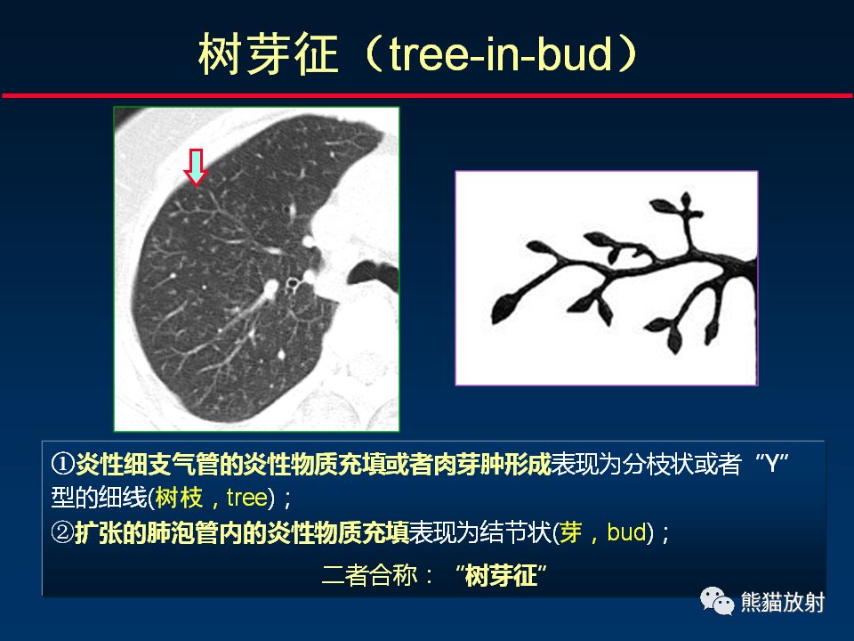 【PPT】正确判读支气管异常的CT征象 【PPT】正确判读支气管异常的CT征象