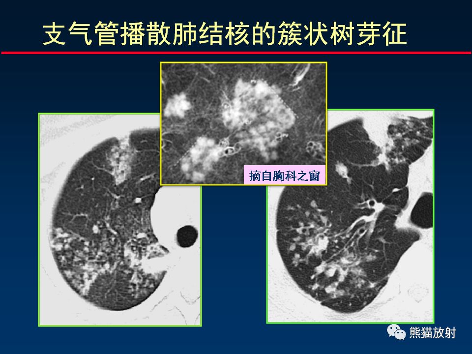 【PPT】正确判读支气管异常的CT征象 【PPT】正确判读支气管异常的CT征象