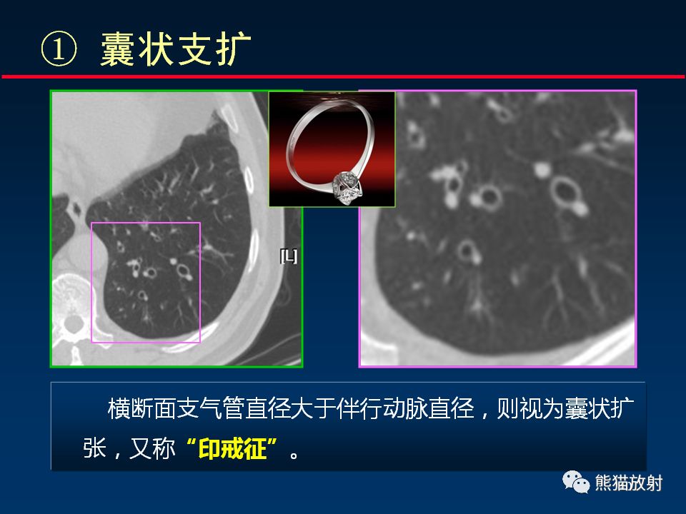【PPT】正确判读支气管异常的CT征象 【PPT】正确判读支气管异常的CT征象
