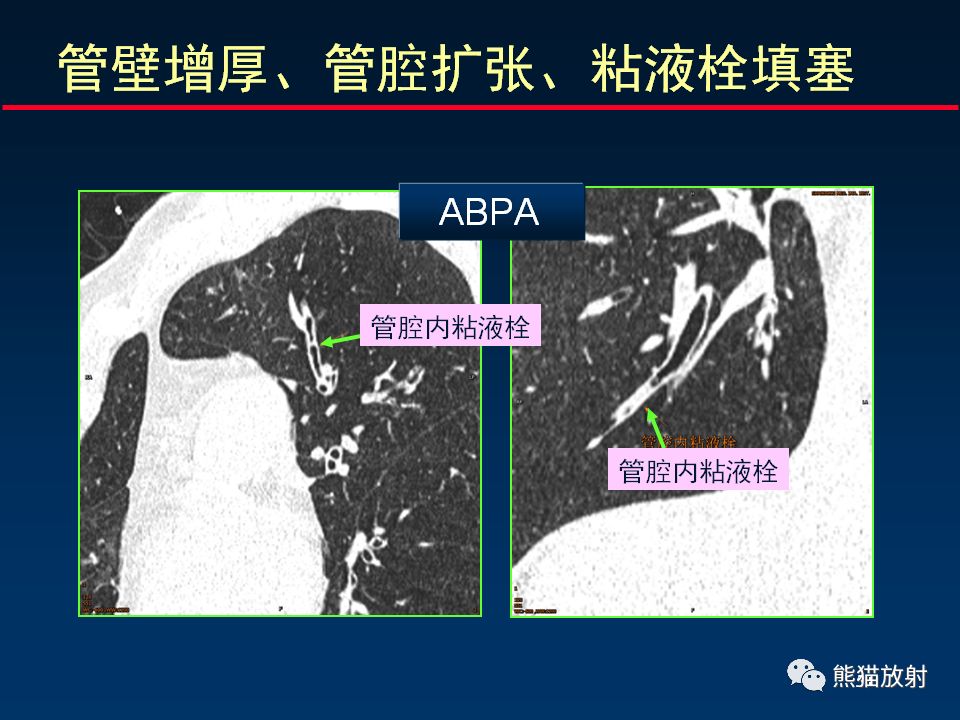 【PPT】正确判读支气管异常的CT征象 【PPT】正确判读支气管异常的CT征象