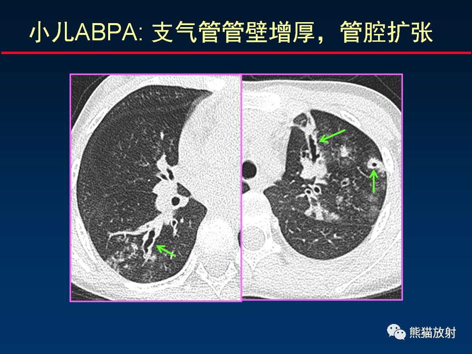 【PPT】正确判读支气管异常的CT征象 【PPT】正确判读支气管异常的CT征象