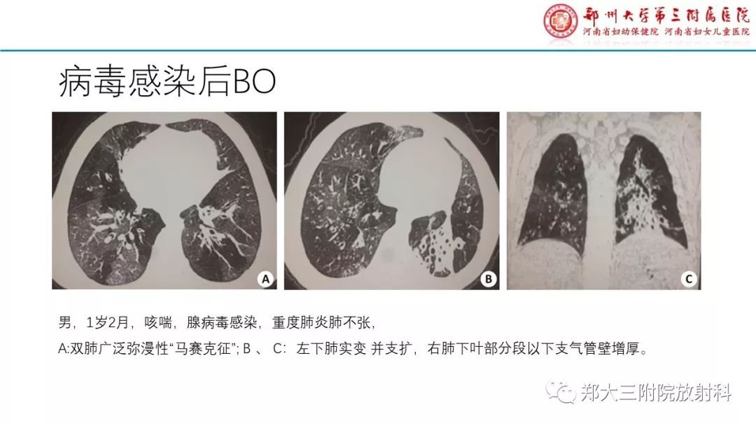 【PPT】闭塞性毛细支气管炎的影像诊断 【PPT】闭塞性毛细支气管炎的影像诊断
