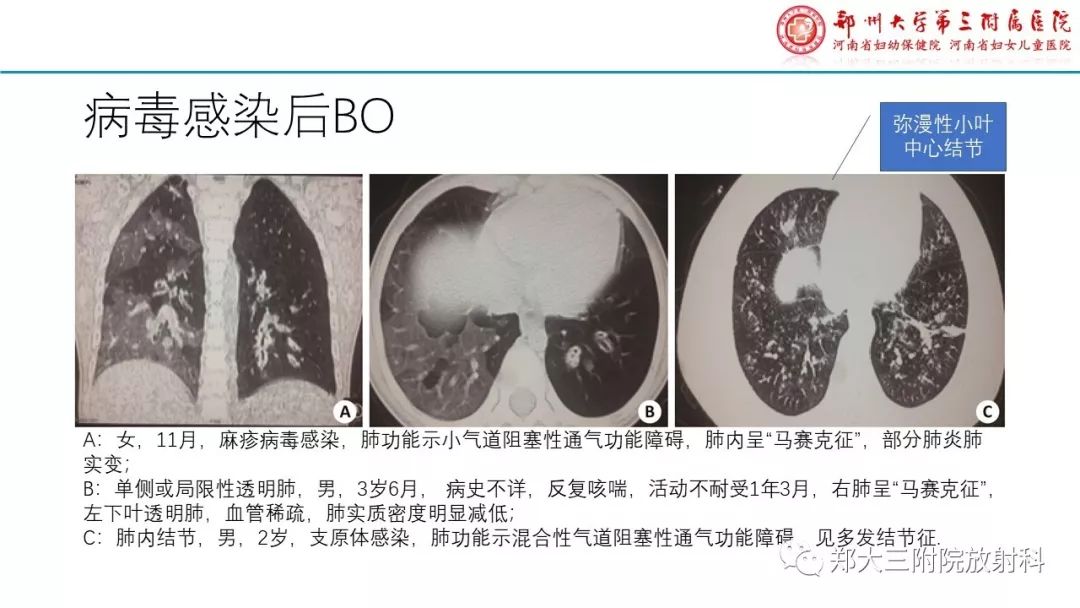 【PPT】闭塞性毛细支气管炎的影像诊断 【PPT】闭塞性毛细支气管炎的影像诊断