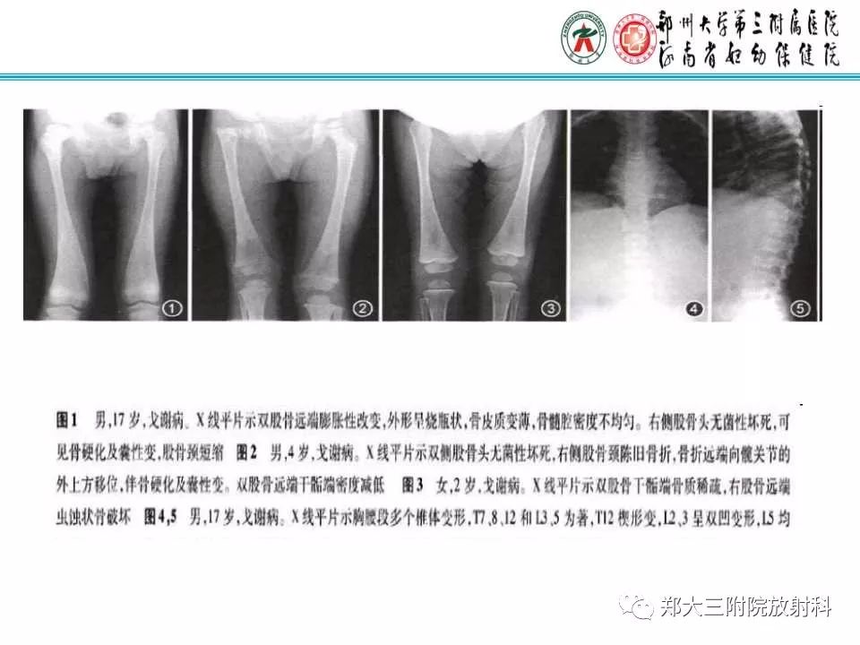 【PPT】戈谢病的影像 【PPT】戈谢病的影像
