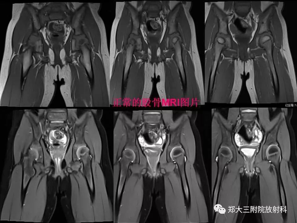 【PPT】戈谢病的影像 【PPT】戈谢病的影像