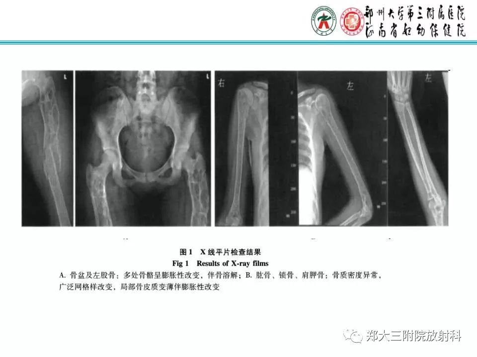 【PPT】戈谢病的影像 【PPT】戈谢病的影像