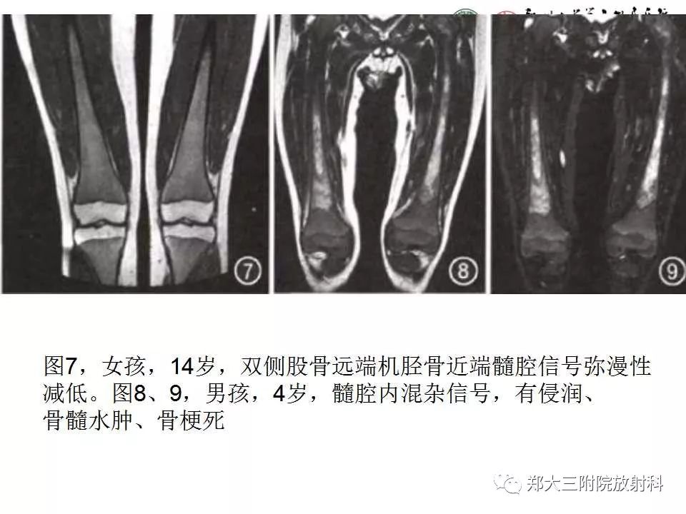 【PPT】戈谢病的影像 【PPT】戈谢病的影像