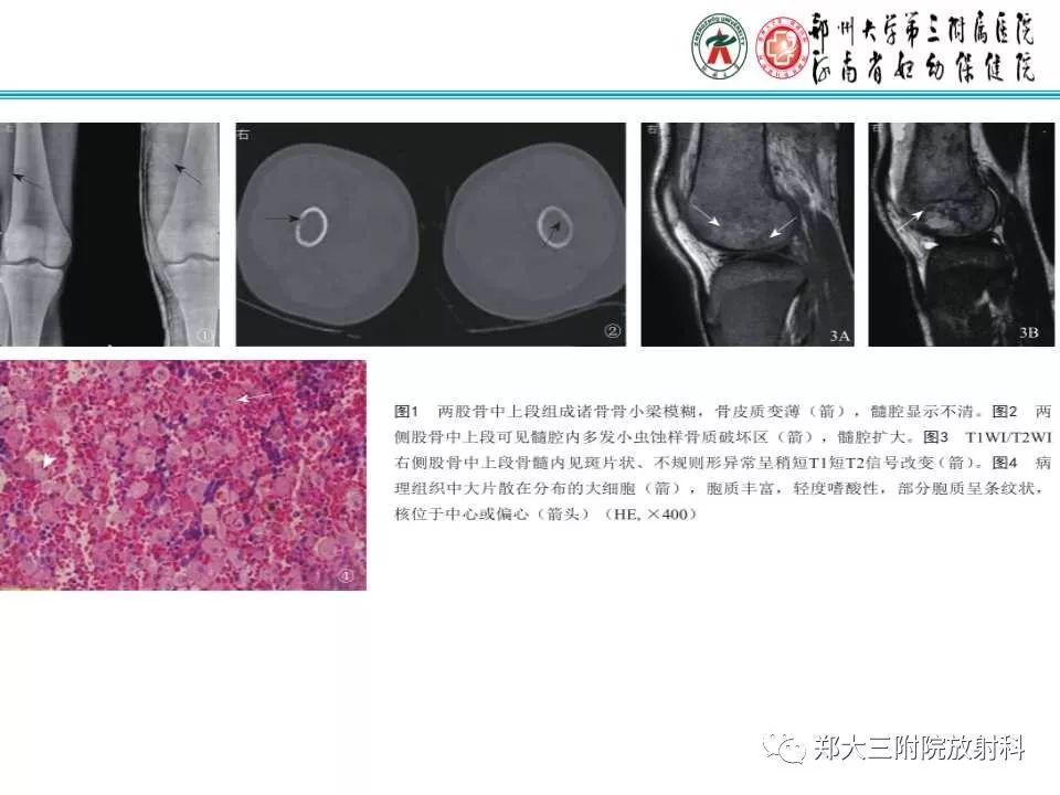 【PPT】戈谢病的影像 【PPT】戈谢病的影像