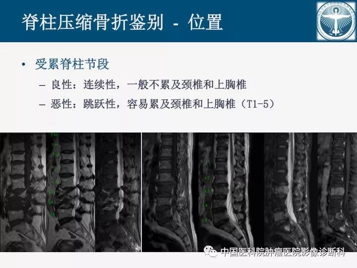 【PPT】椎体压缩骨折MRI鉴别诊断 【PPT】椎体压缩骨折MRI鉴别诊断