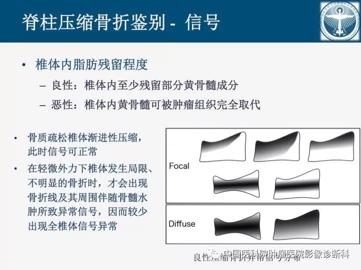 【PPT】椎体压缩骨折MRI鉴别诊断 【PPT】椎体压缩骨折MRI鉴别诊断