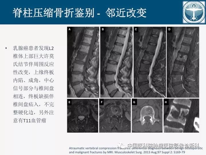 【PPT】椎体压缩骨折MRI鉴别诊断 【PPT】椎体压缩骨折MRI鉴别诊断