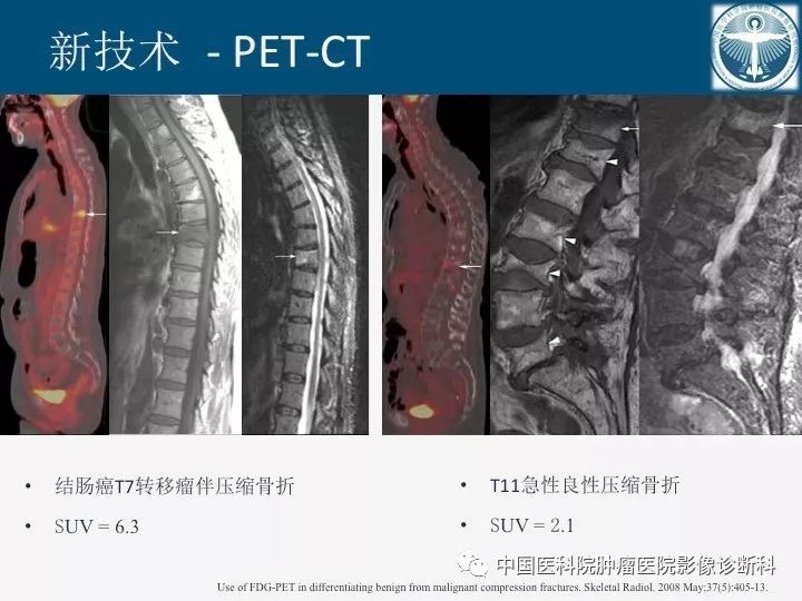 【PPT】椎体压缩骨折MRI鉴别诊断 【PPT】椎体压缩骨折MRI鉴别诊断