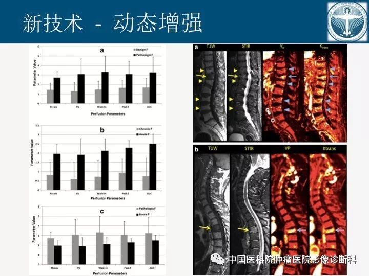 【PPT】椎体压缩骨折MRI鉴别诊断 【PPT】椎体压缩骨折MRI鉴别诊断