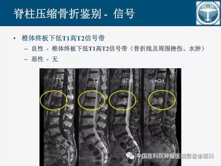 【PPT】椎体压缩骨折MRI鉴别诊断 【PPT】椎体压缩骨折MRI鉴别诊断