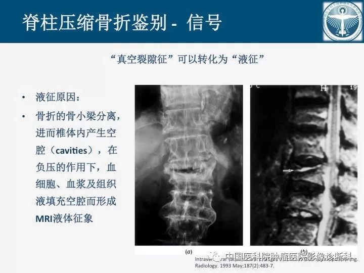 【PPT】椎体压缩骨折MRI鉴别诊断 【PPT】椎体压缩骨折MRI鉴别诊断
