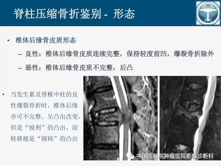 【PPT】椎体压缩骨折MRI鉴别诊断 【PPT】椎体压缩骨折MRI鉴别诊断