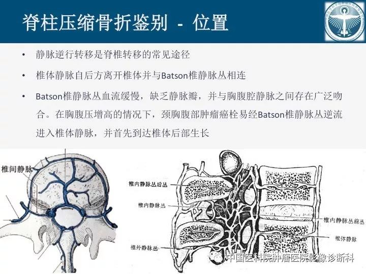 【PPT】椎体压缩骨折MRI鉴别诊断 【PPT】椎体压缩骨折MRI鉴别诊断