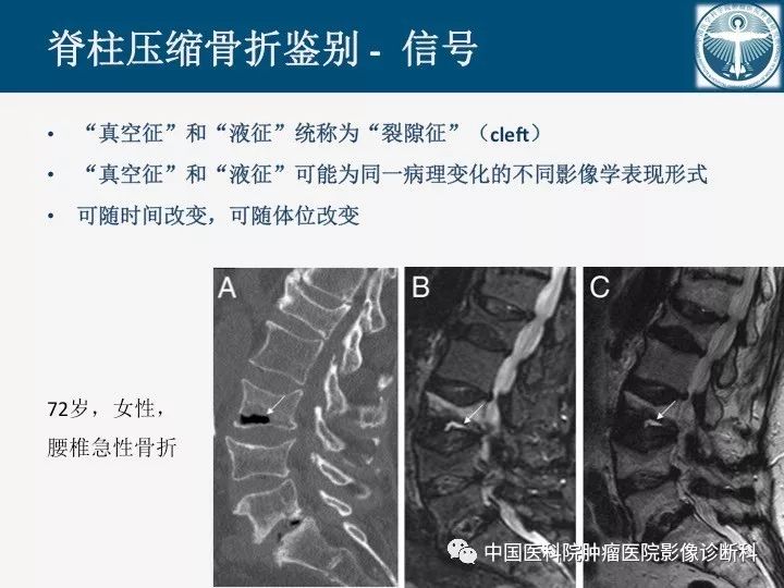 【PPT】椎体压缩骨折MRI鉴别诊断 【PPT】椎体压缩骨折MRI鉴别诊断