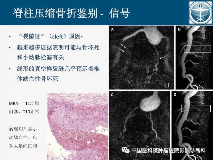 【PPT】椎体压缩骨折MRI鉴别诊断 【PPT】椎体压缩骨折MRI鉴别诊断