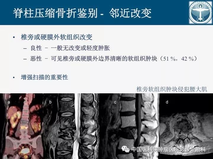 【PPT】椎体压缩骨折MRI鉴别诊断 【PPT】椎体压缩骨折MRI鉴别诊断