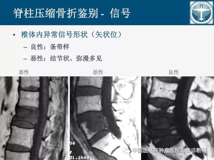 【PPT】椎体压缩骨折MRI鉴别诊断 【PPT】椎体压缩骨折MRI鉴别诊断