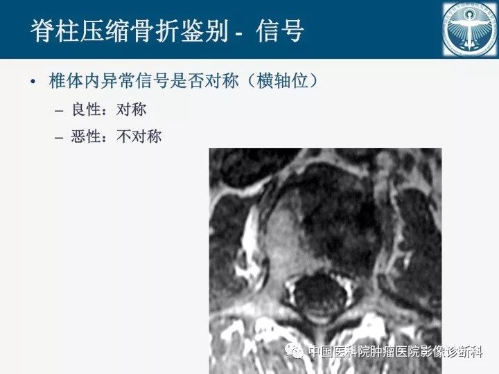 【PPT】椎体压缩骨折MRI鉴别诊断 【PPT】椎体压缩骨折MRI鉴别诊断