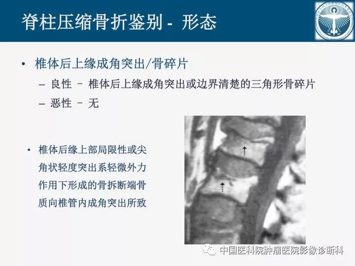 【PPT】椎体压缩骨折MRI鉴别诊断 【PPT】椎体压缩骨折MRI鉴别诊断