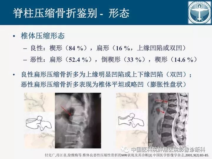 【PPT】椎体压缩骨折MRI鉴别诊断 【PPT】椎体压缩骨折MRI鉴别诊断