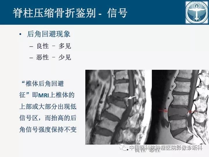 【PPT】椎体压缩骨折MRI鉴别诊断 【PPT】椎体压缩骨折MRI鉴别诊断