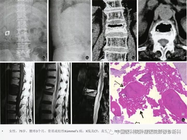 【PPT】椎体压缩骨折MRI鉴别诊断 【PPT】椎体压缩骨折MRI鉴别诊断