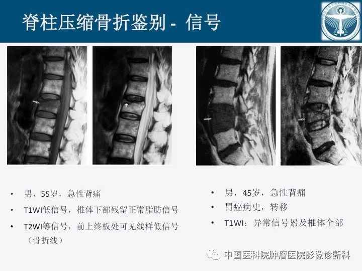 【PPT】椎体压缩骨折MRI鉴别诊断 【PPT】椎体压缩骨折MRI鉴别诊断
