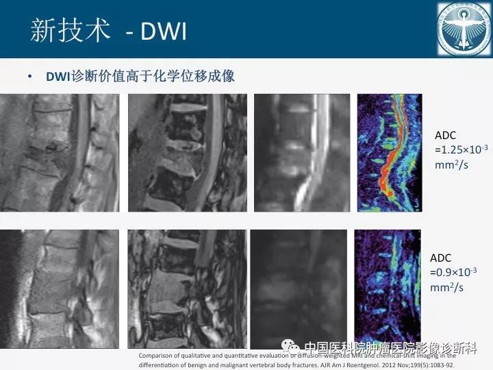 【PPT】椎体压缩骨折MRI鉴别诊断 【PPT】椎体压缩骨折MRI鉴别诊断