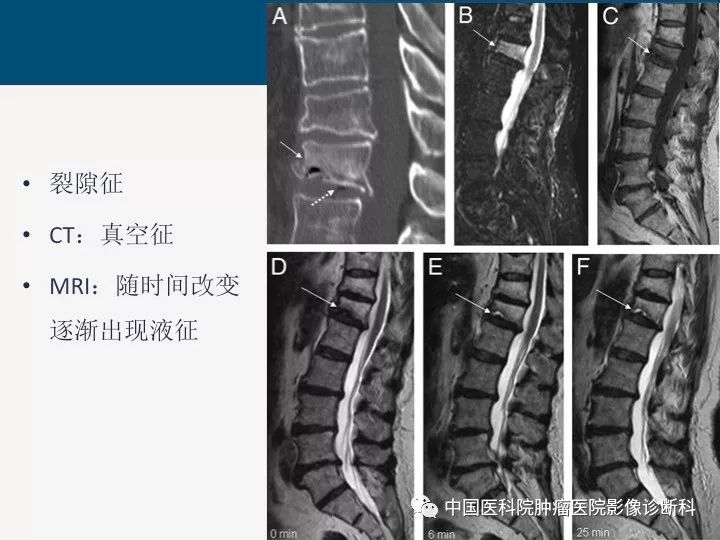 【PPT】椎体压缩骨折MRI鉴别诊断 【PPT】椎体压缩骨折MRI鉴别诊断