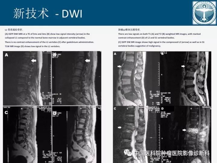 【PPT】椎体压缩骨折MRI鉴别诊断 【PPT】椎体压缩骨折MRI鉴别诊断