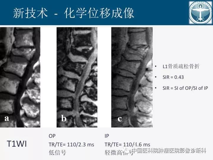 【PPT】椎体压缩骨折MRI鉴别诊断 【PPT】椎体压缩骨折MRI鉴别诊断