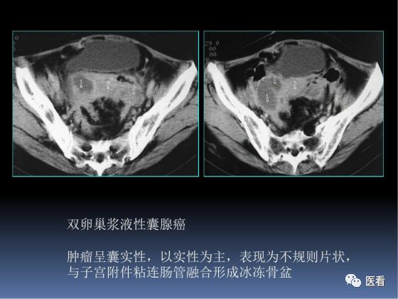 【PPT】卵巢恶性肿瘤的CT诊断