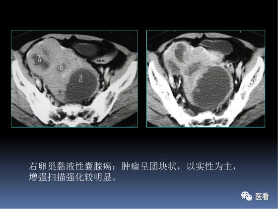 【PPT】卵巢恶性肿瘤的CT诊断