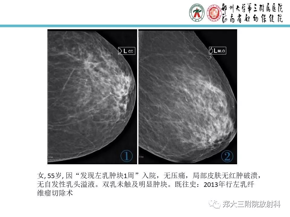 【PPT】乳腺囊肿的X线表现 【PPT】乳腺囊肿的X线表现