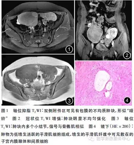 【病例】腹膜弥漫性平滑肌瘤病一例MR影像