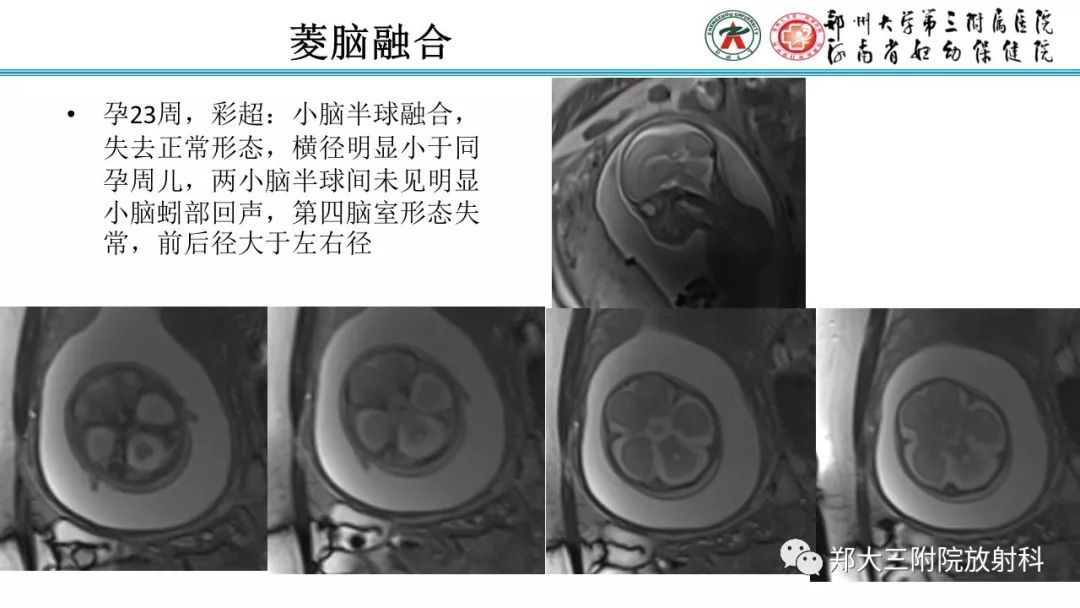 【PPT】胎儿小脑发育及常见疾病的MRI评估 【PPT】胎儿小脑发育及常见疾病的MRI评估