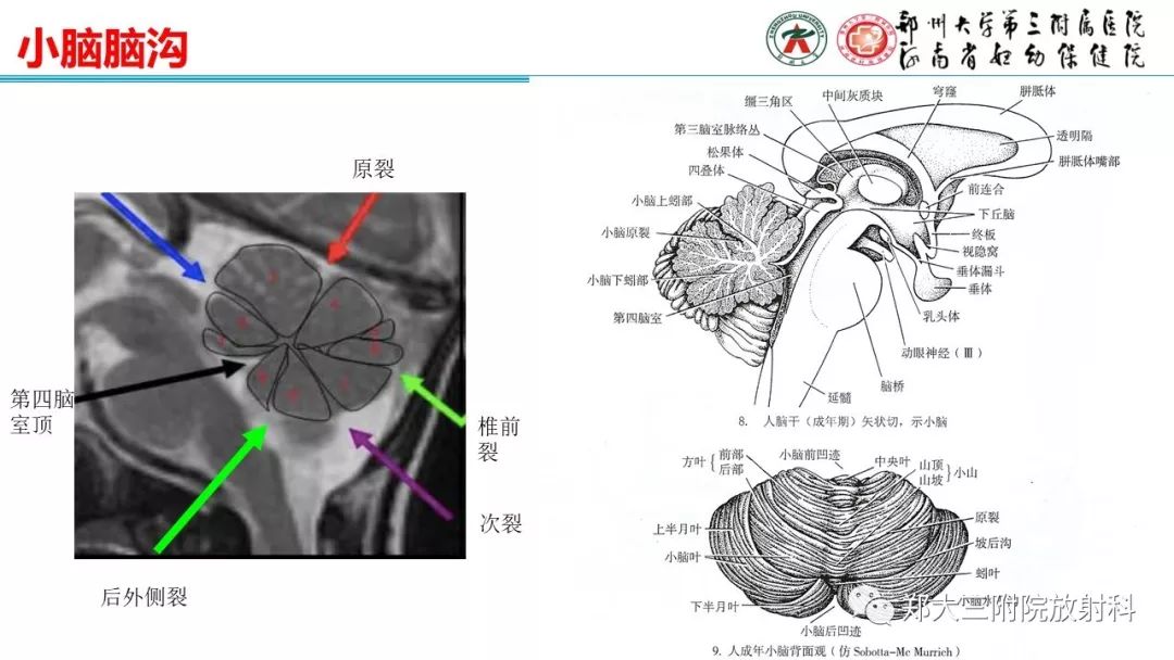 【PPT】胎儿小脑发育及常见疾病的MRI评估 【PPT】胎儿小脑发育及常见疾病的MRI评估