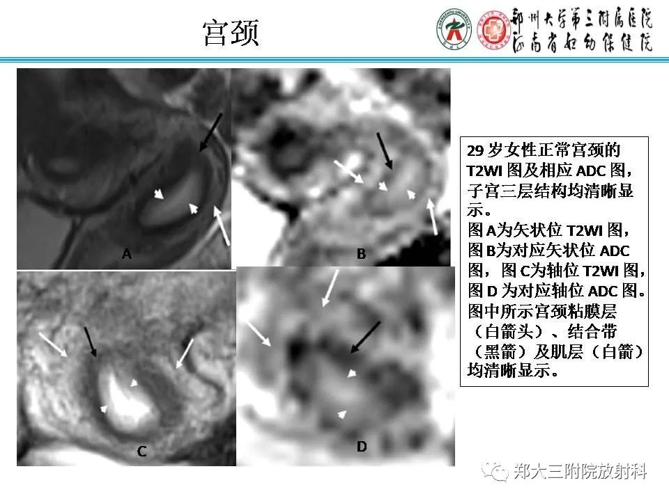 【PPT】育龄期女性正常子宫的MRI表现