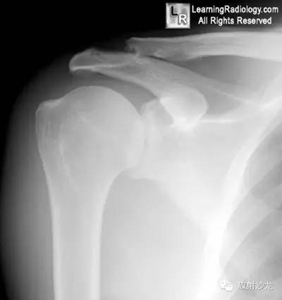 【病例】锁骨远端骨质溶解1例X线影像表现